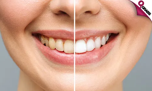 Zoom Teeth Whitening + Consultation at Ocean Medical Center!